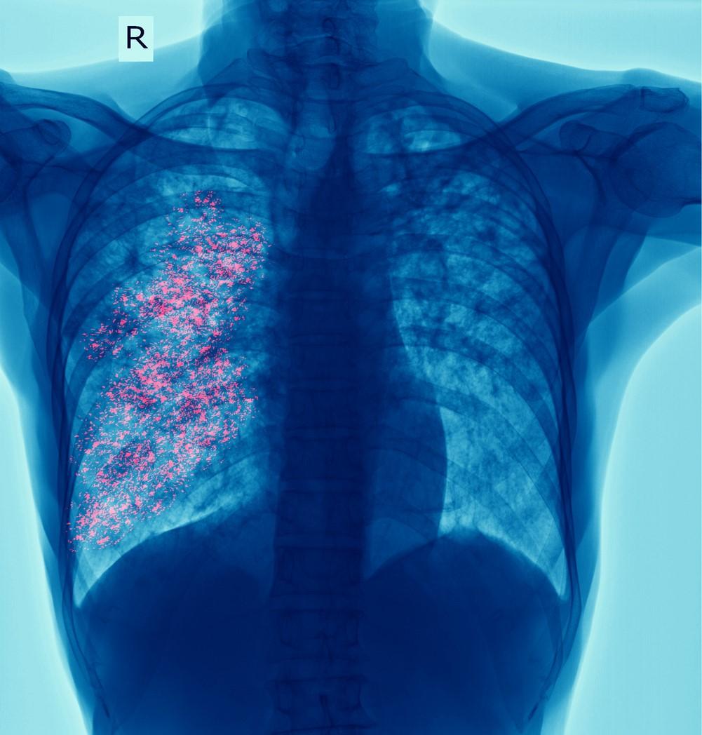 TB x-ray