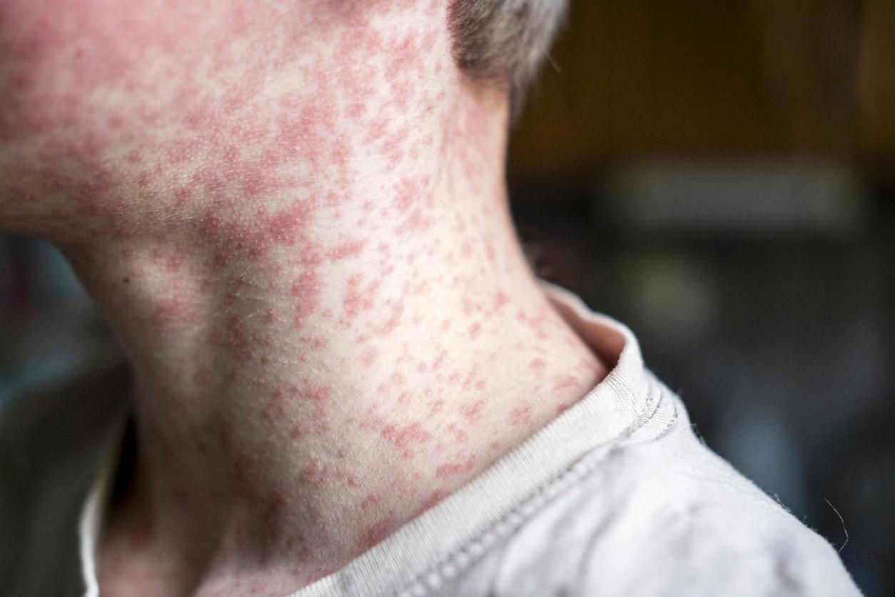 measles 