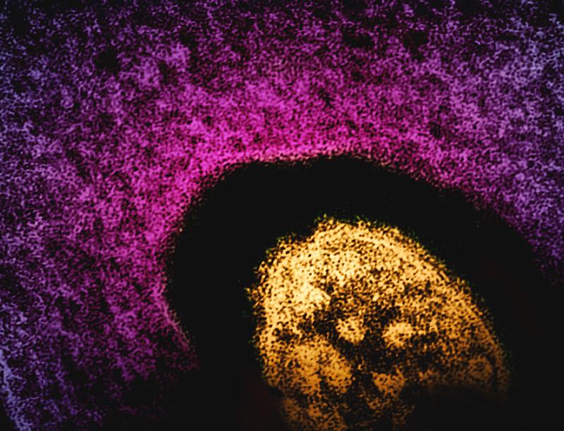 measles pic 