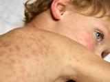 young boy with measles